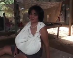 Thailand Woman Whose Breast Won't Stop Growing