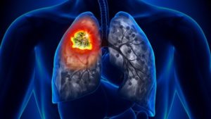 New research shows that lung condition is increasing in non-smokers