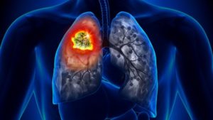 New research shows that lung condition is increasing in non-smokers