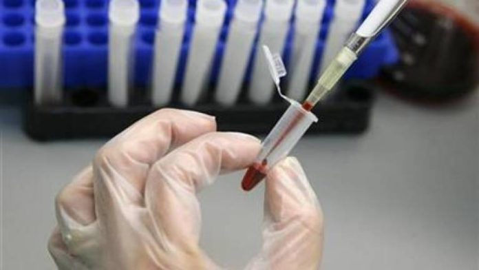 Lockdown Will See To Rise In HIV Infections - Experts Warn
